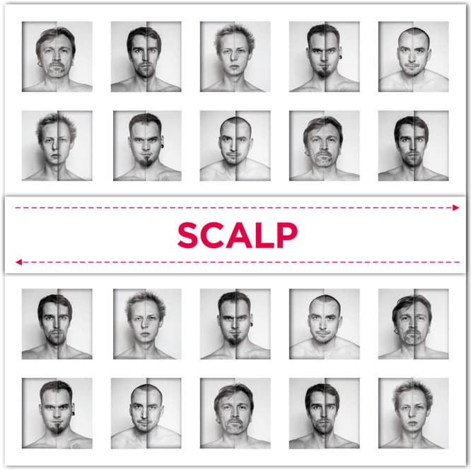 Scalp
